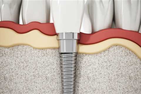 Can dental implants cause cancer?