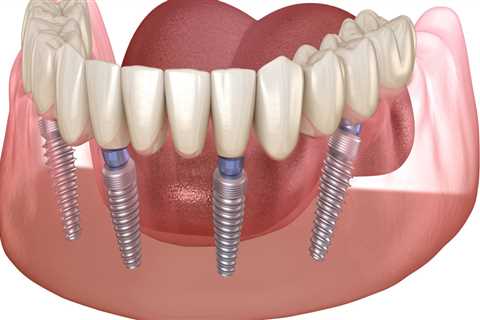 Why are full mouth implants so expensive?