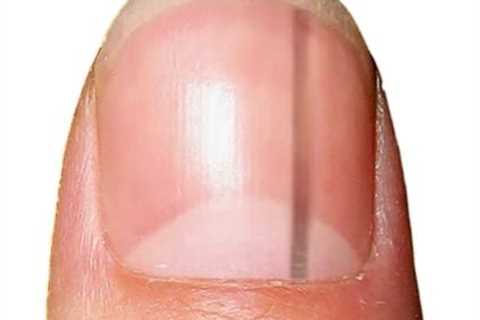 Horrifying Time-Lapse Video Reveals Nail 'Blemish' Can Turn into Stage 4 Cancer