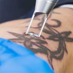 Everything You Need to Know About Laser Tattoo Removal