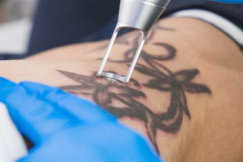 Everything You Need to Know About Laser Tattoo Removal