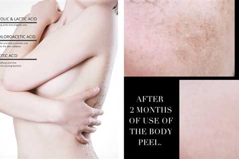 Unlock the Secret to Smoother Skin: The Power of TCA Body Peels