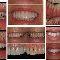 How Long Will the Results of a Smile Makeover Last?