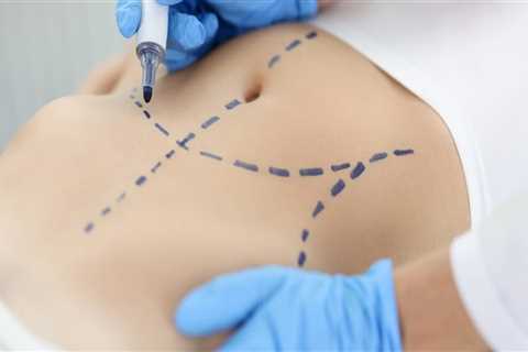 Tummy Tuck Surgery In New Jersey: The Superior Option To Nonsurgical Fat Reduction For A Sculpted..