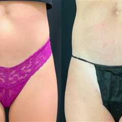Liposuction In Scottsdale: A Nonsurgical Fat Reduction Option Worth Exploring
