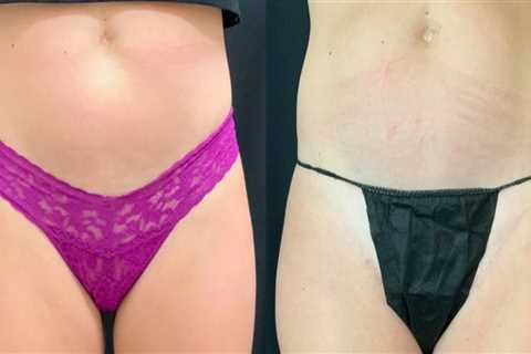 Liposuction In Scottsdale: A Nonsurgical Fat Reduction Option Worth Exploring