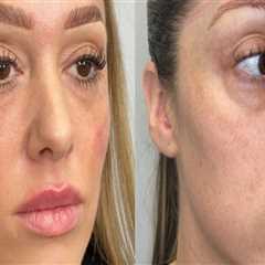 The Professional Difference: Dermal Fillers Vs. Natural Remedies For Anti-aging In Scottsdale, AZ