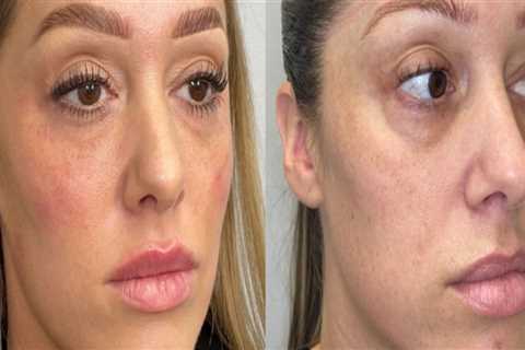 The Professional Difference: Dermal Fillers Vs. Natural Remedies For Anti-aging In Scottsdale, AZ