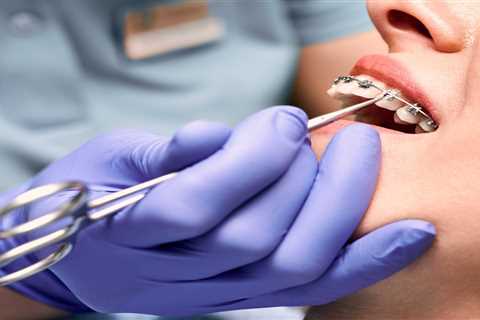 Dealing with Broken Brackets or Wires on Standard Braces