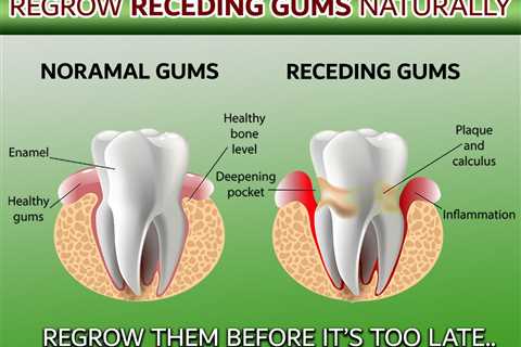 A New Approach To Gum Health: Repairing Gum Recession