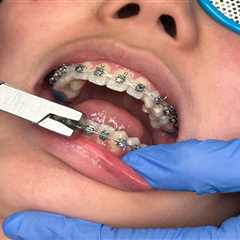 A Complete Guide to Traditional Braces in Sanger: From Consultation to Removal