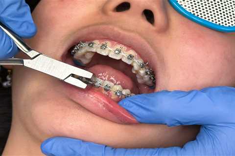 A Complete Guide to Traditional Braces in Sanger: From Consultation to Removal