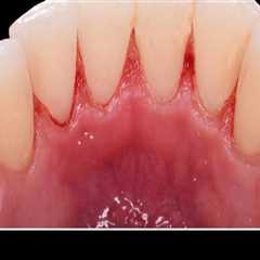 Understanding Sensitivity After Teeth Cleaning: What You Need to Know