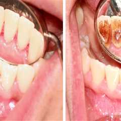 Understanding the Risks and Benefits of Teeth Cleaning