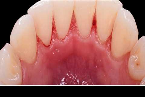 Understanding Sensitivity After Teeth Cleaning: What You Need to Know