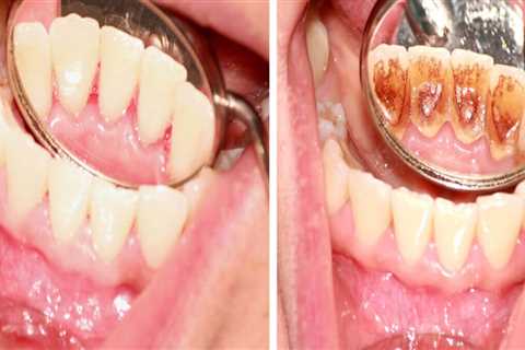 Understanding the Risks and Benefits of Teeth Cleaning