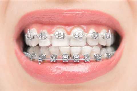 How to Make Metal Braces Less Noticeable