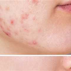 Achieve Flawless Everyday Makeup with Expert Acne Treatments