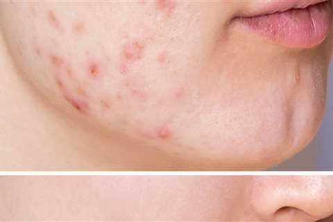 Achieve Flawless Everyday Makeup with Expert Acne Treatments