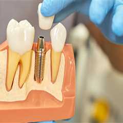 Why Temporary Prosthetics Are an Important Part of the All-on-Four Process