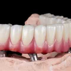 The Hidden Challenges of Adapting to Full-Arch Implant-Supported Dentures